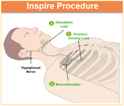 ins-procedure