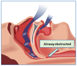 airway-obstructed-300x258.png